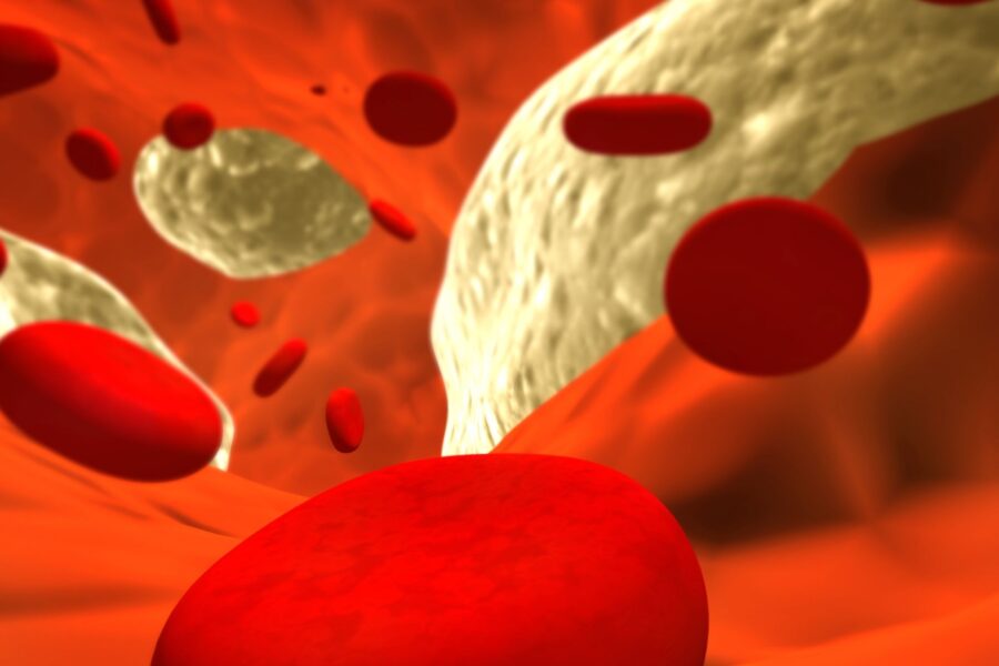 ¿Qué es la aterosclerosis?